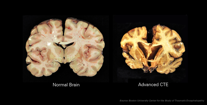 Chronic Traumatic Encephalopathy (CTE) brain